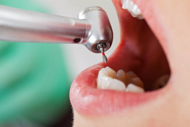 Best Emergency Tooth Extraction in River Falls, WI